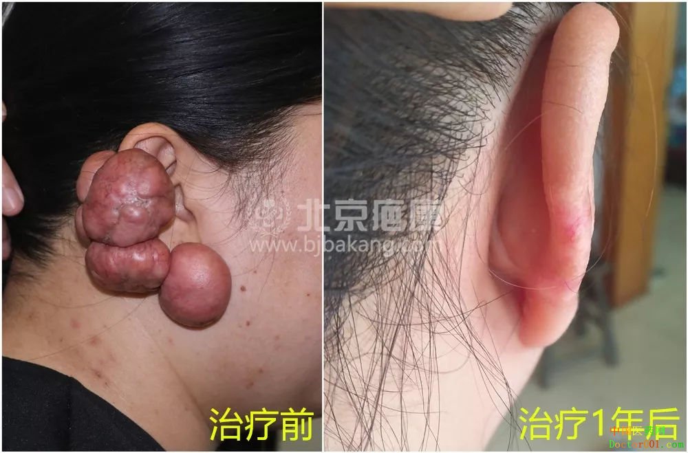 李女士耳朵疤痕疙瘩长得像“土豆”,北京疤康疤友故事 李女士耳朵疤痕疙瘩长得像“土豆”,北京疤康疤友故事