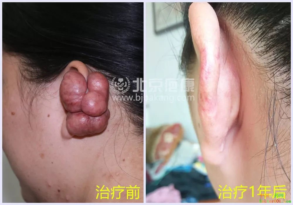 李女士耳朵疤痕疙瘩长得像“土豆”,北京疤康疤友故事 李女士耳朵疤痕疙瘩长得像“土豆”,北京疤康疤友故事