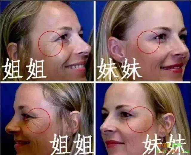 botox΢����